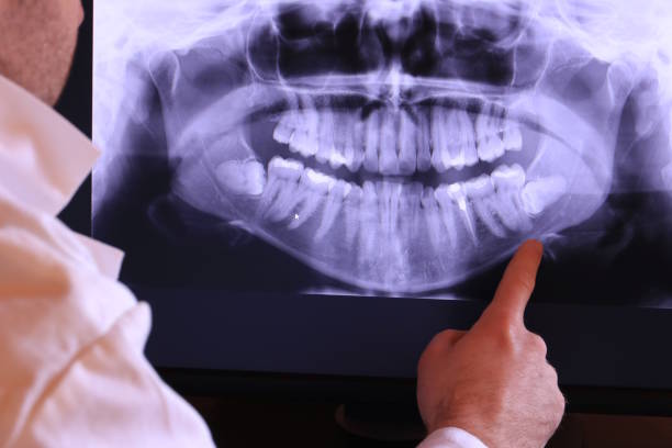 Best Emergency Wisdom Teeth Removal in Lusk, WY