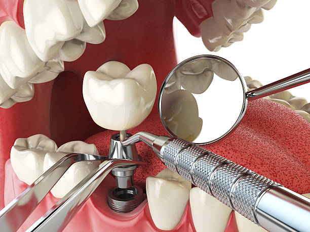 Best Emergency Dental Care for Broken or Chipped Teeth in Lusk, WY